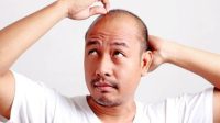 Begini Cara Mudah Mengatasi Masalah Kebotakan 7 Inilah Beberapa jenis Rambut Botak penumbuh rambut