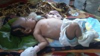 Tambah Parah, Bayi Wahyuni Masuk IGD RSUD Pandan 15 balita idap penyakit pembengkakan