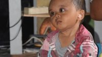 Bocah di Sibolga Ini 2 Tahun Melawan Kanker di Kepala 1 derita sakit