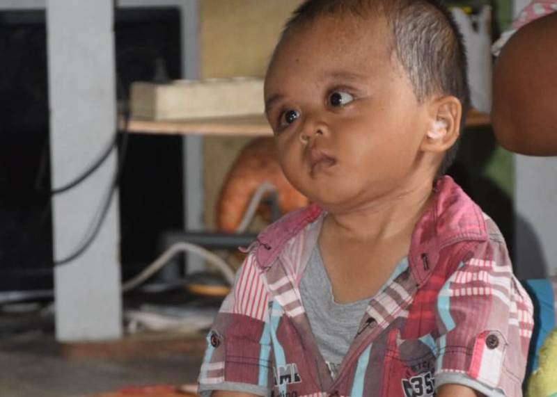 Bocah di Sibolga Ini 2 Tahun Melawan Kanker di Kepala 1 derita sakit